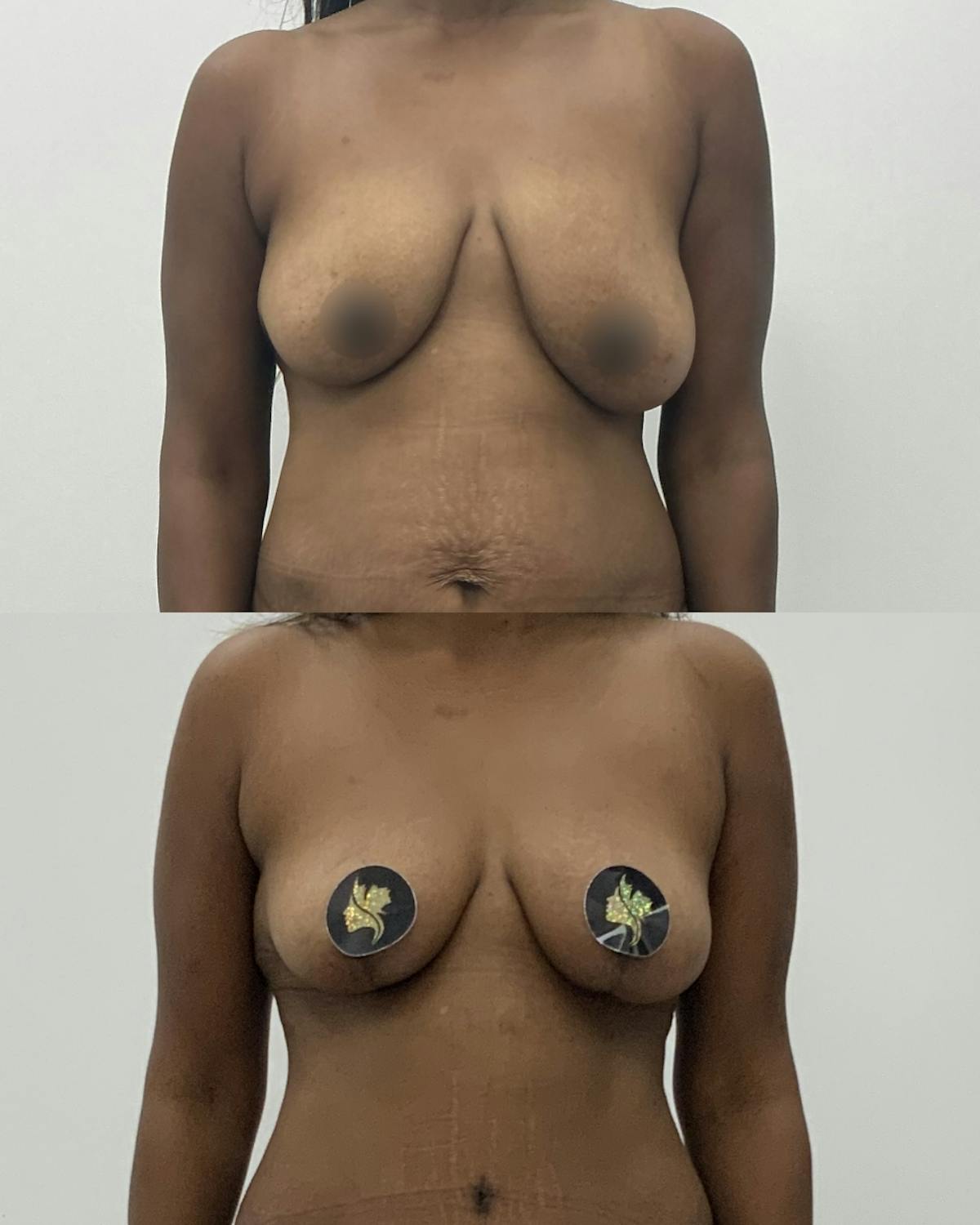 Breast Asymmetry Correction Before & After Gallery - Patient 412402 - Image 1