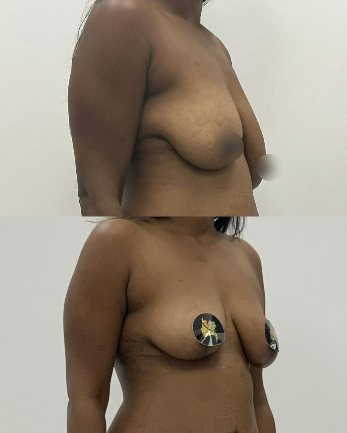 Breast Asymmetry Correction Before & After Gallery - Patient 412402 - Image 2