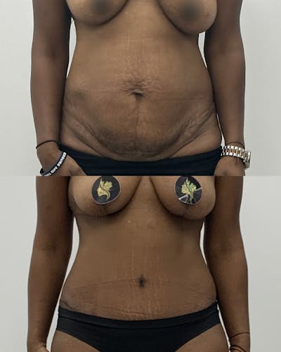 Tummy Tuck Before & After Gallery - Patient 120728 - Image 1