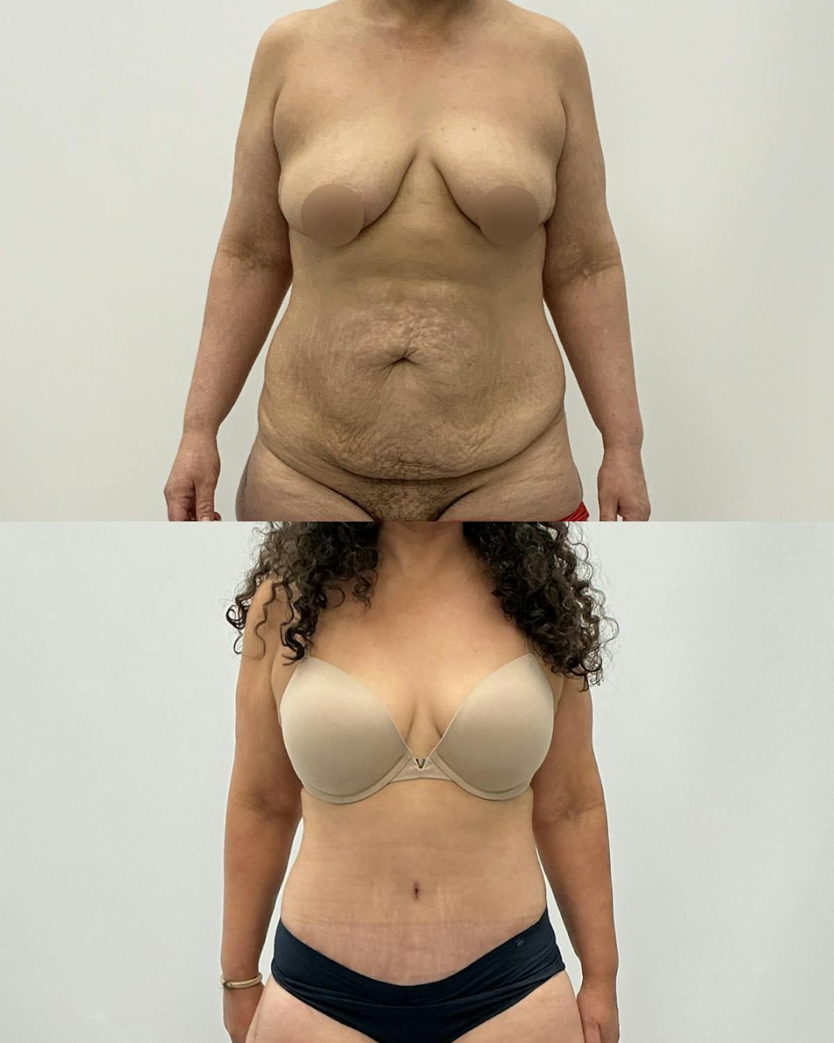 Tummy Tuck Before & After Gallery - Patient 291567 - Image 1