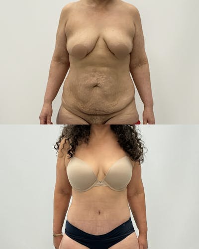 Tummy Tuck Before & After Gallery - Patient 291567 - Image 1