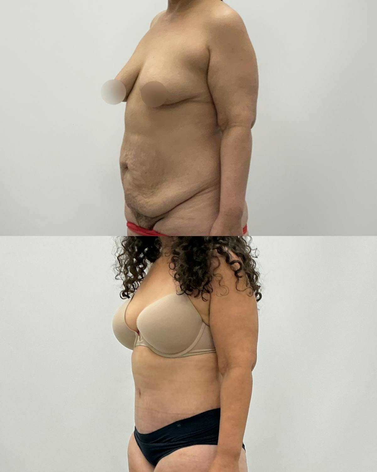 Tummy Tuck Before & After Gallery - Patient 291567 - Image 2