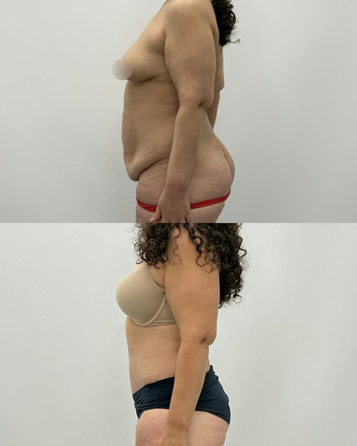 Tummy Tuck Before & After Gallery - Patient 291567 - Image 3
