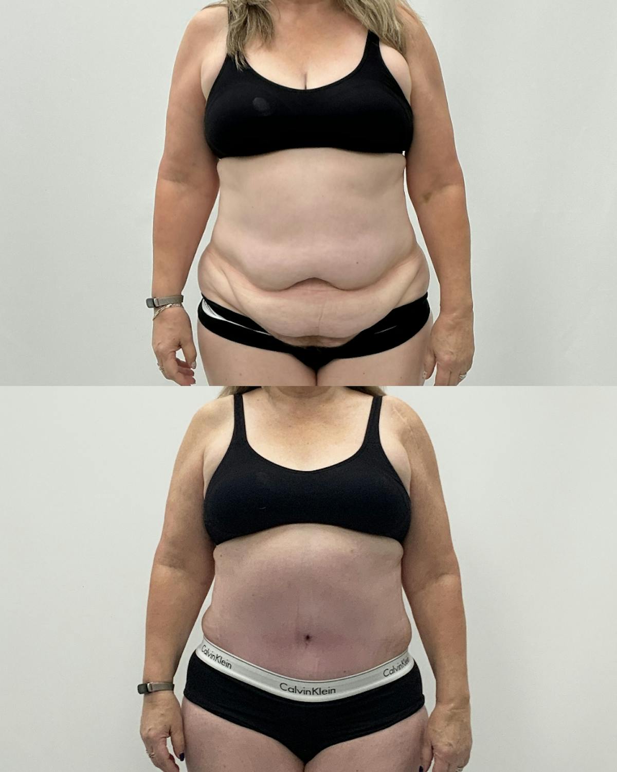 Tummy Tuck Before & After Gallery - Patient 203276 - Image 1