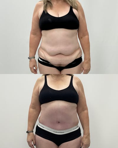 Tummy Tuck Before & After Gallery - Patient 203276 - Image 1
