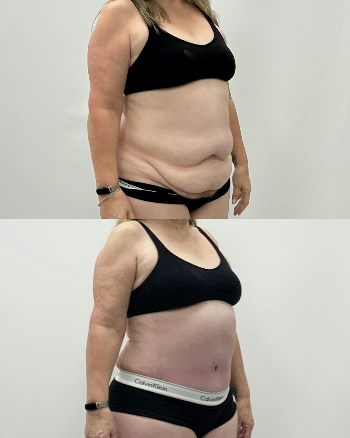 Tummy Tuck Before & After Gallery - Patient 203276 - Image 2