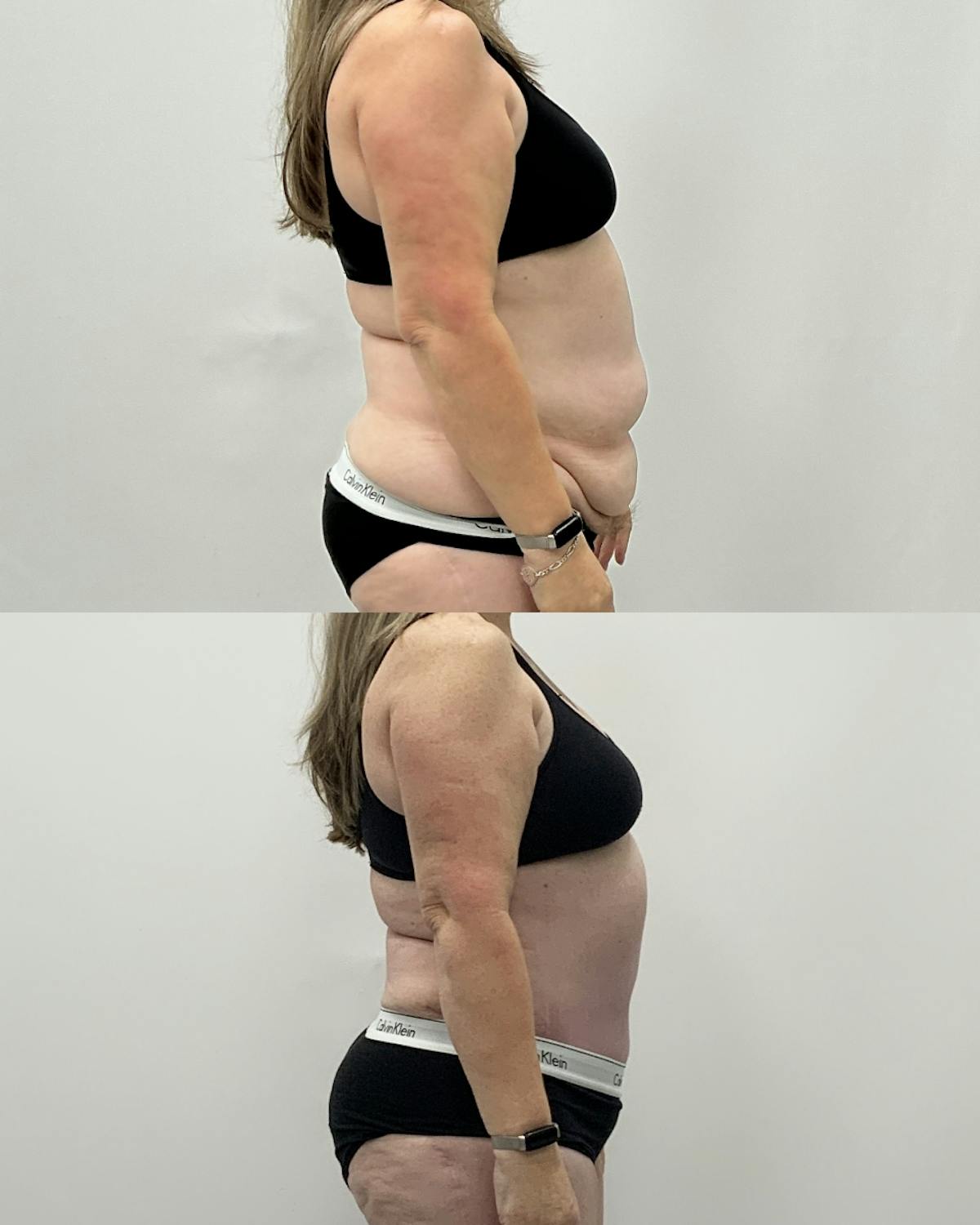 Tummy Tuck Before & After Gallery - Patient 203276 - Image 3