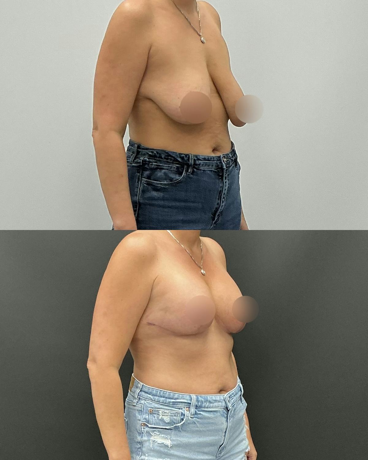 Breast Lift Before & After Gallery - Patient 287096 - Image 2