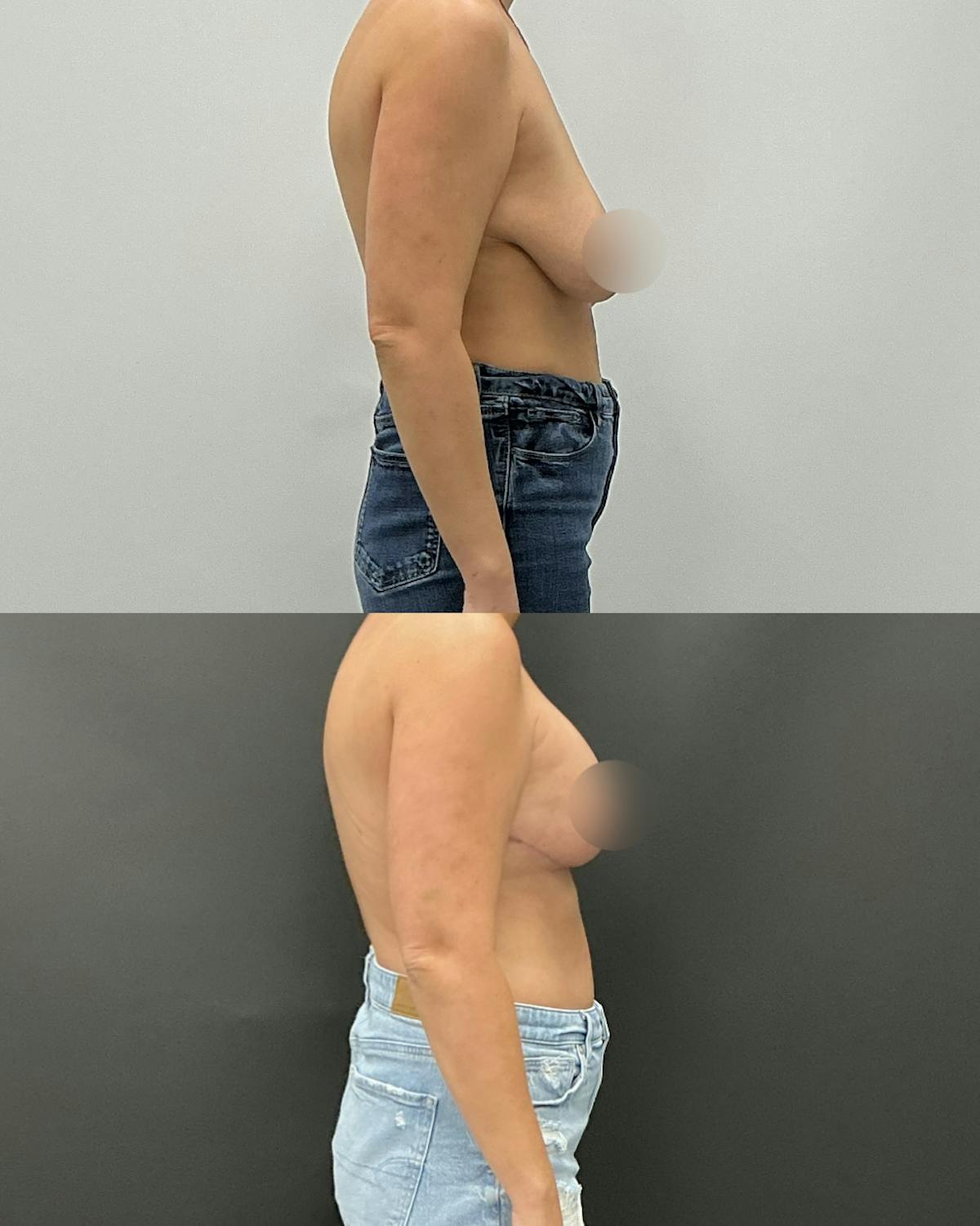 Breast Lift Before & After Gallery - Patient 287096 - Image 3