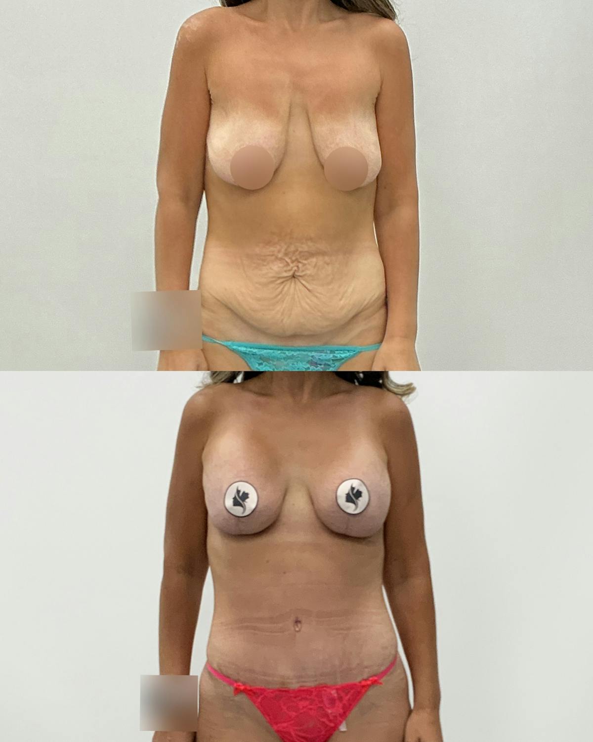 Mommy Makeover Before & After Gallery - Patient 288882 - Image 1