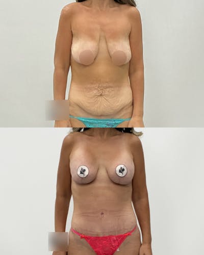 Mommy Makeover Before & After Gallery - Patient 288882 - Image 1
