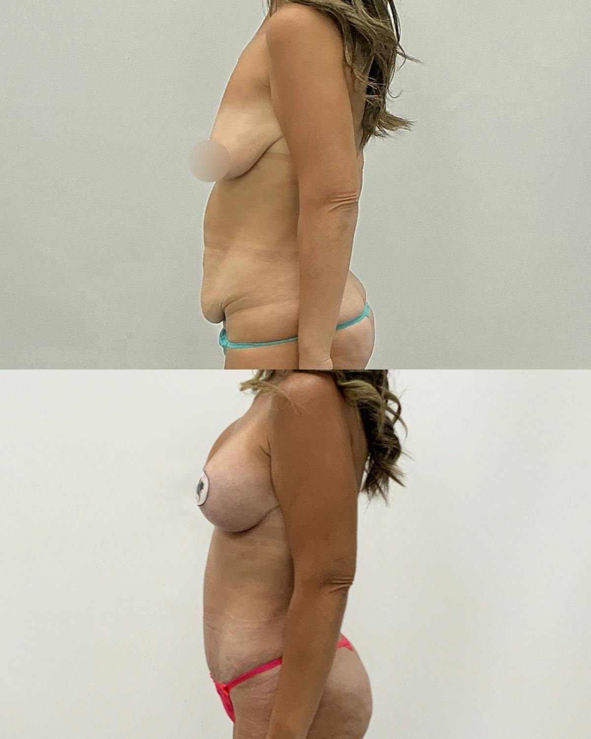 Mommy Makeover Before & After Gallery - Patient 288882 - Image 3