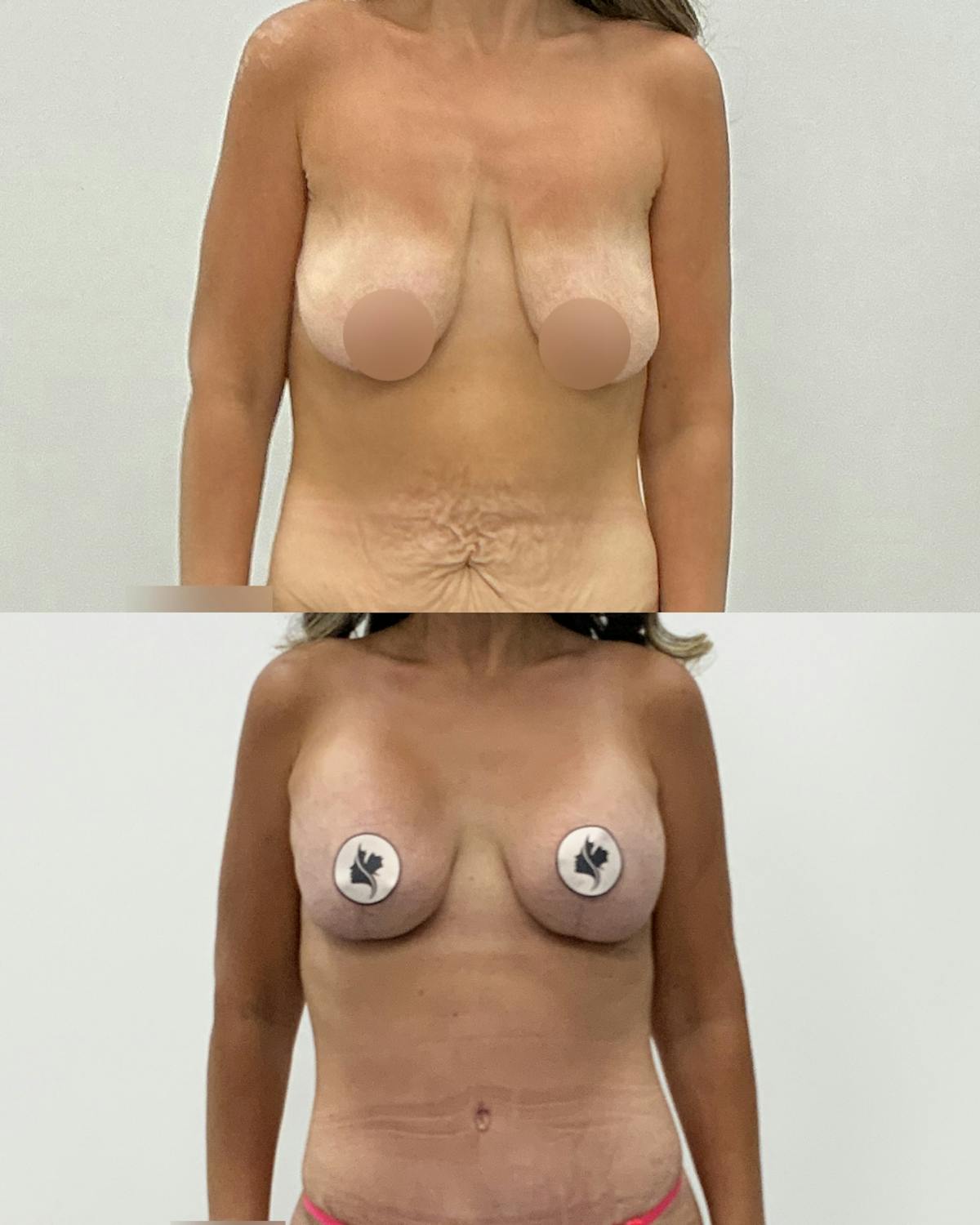 Breast Lift Before & After Gallery - Patient 358724 - Image 1