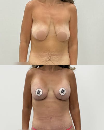 Breast Lift Before & After Gallery - Patient 358724 - Image 1