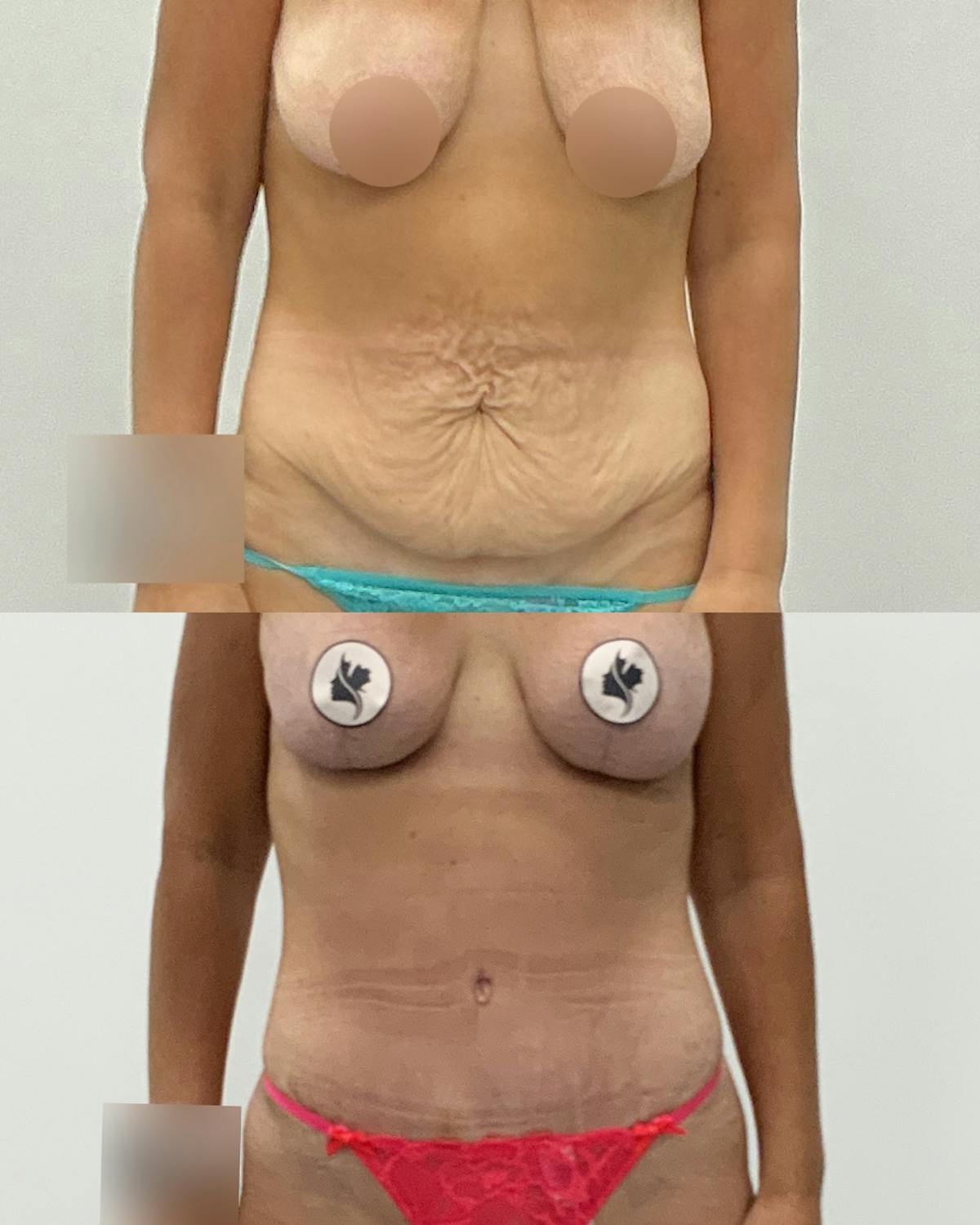 Tummy Tuck Before & After Gallery - Patient 924893 - Image 1
