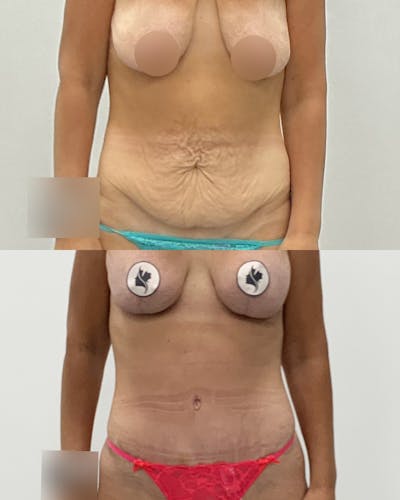 Tummy Tuck Before & After Gallery - Patient 924893 - Image 1