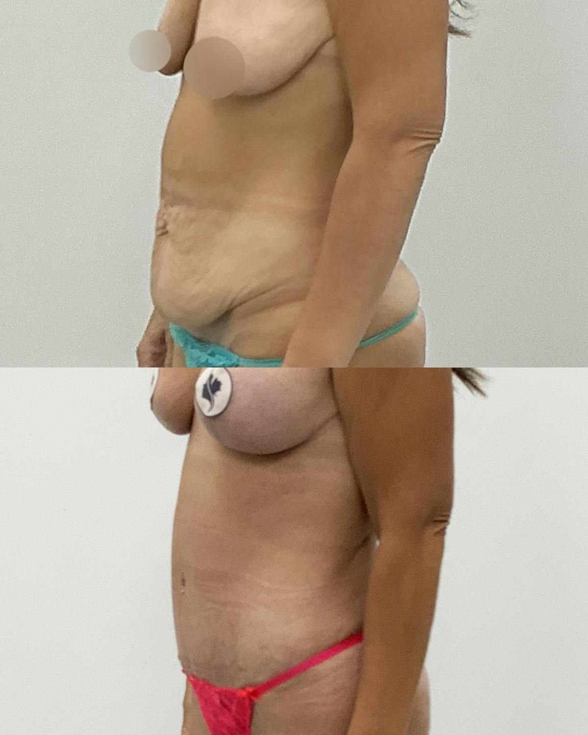 Tummy Tuck Before & After Gallery - Patient 924893 - Image 2