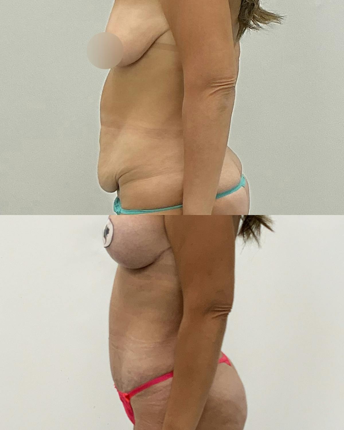 Tummy Tuck Before & After Gallery - Patient 924893 - Image 3