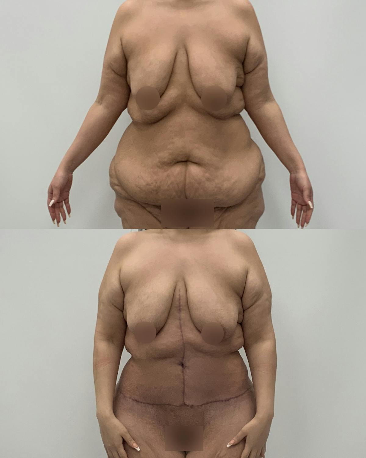 Post-Bariatric Body Contouring Before & After Gallery - Patient 199165 - Image 1