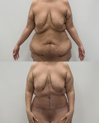 Post-Bariatric Body Contouring Before & After Gallery - Patient 199165 - Image 1