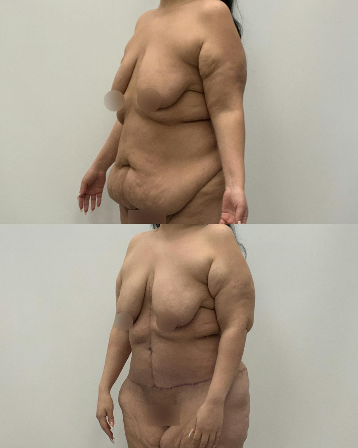 Post-Bariatric Body Contouring Before & After Gallery - Patient 199165 - Image 2