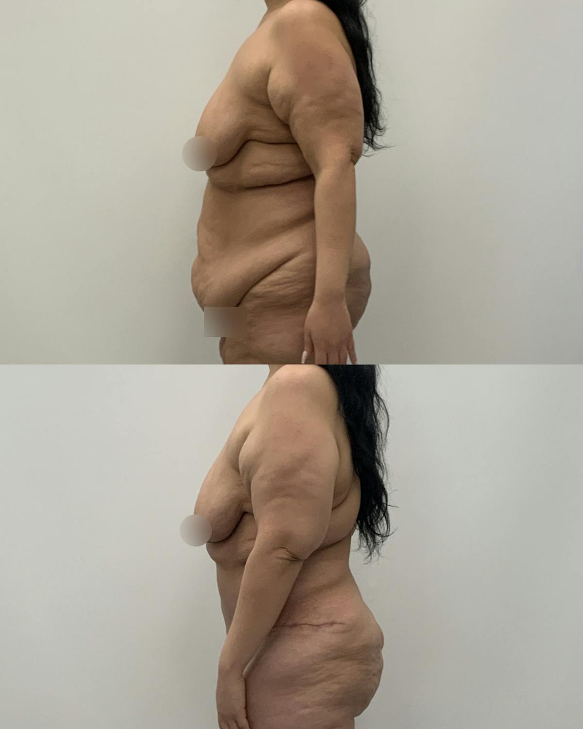 Post-Bariatric Body Contouring Before & After Gallery - Patient 199165 - Image 3
