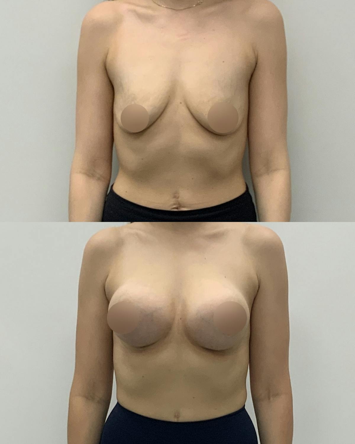 Breast Augmentation Before & After Gallery - Patient 181063 - Image 1