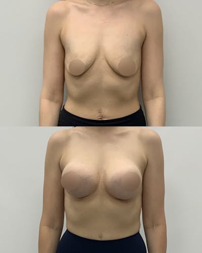 Breast Augmentation Before & After Gallery - Patient 181063 - Image 1