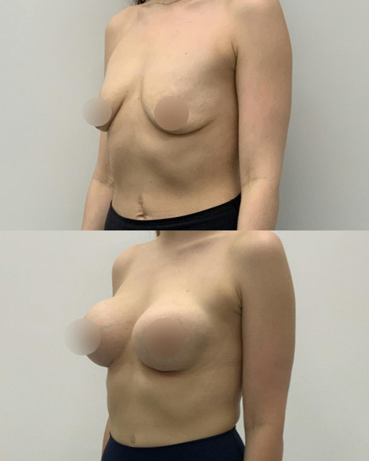Breast Augmentation Before & After Gallery - Patient 181063 - Image 2