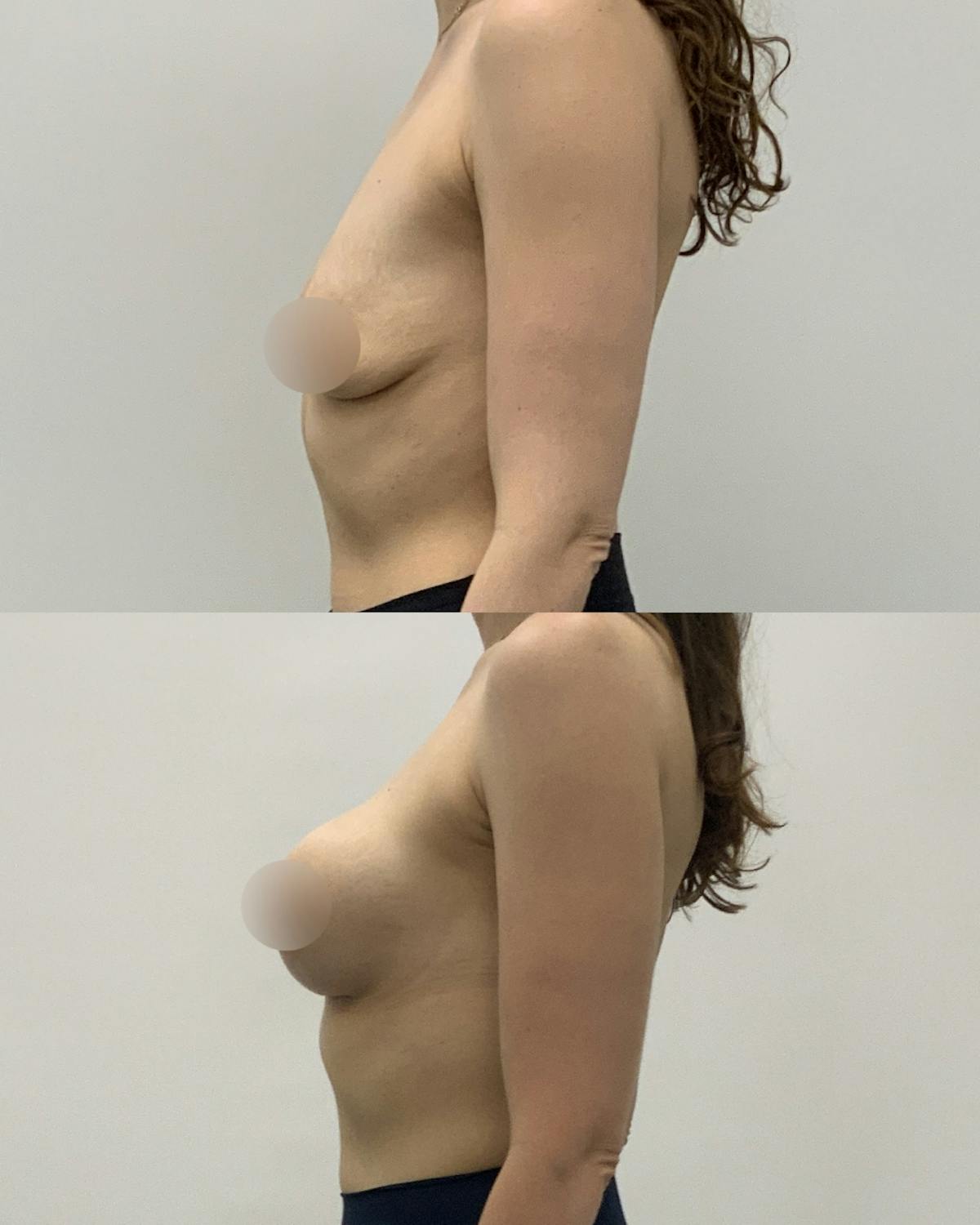 Breast Augmentation Before & After Gallery - Patient 181063 - Image 3