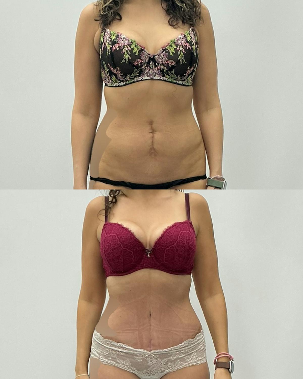 Tummy Tuck Before & After Gallery - Patient 202749 - Image 1
