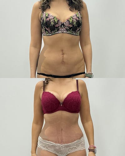 Mommy Makeover Before & After Gallery - Patient 278806 - Image 1
