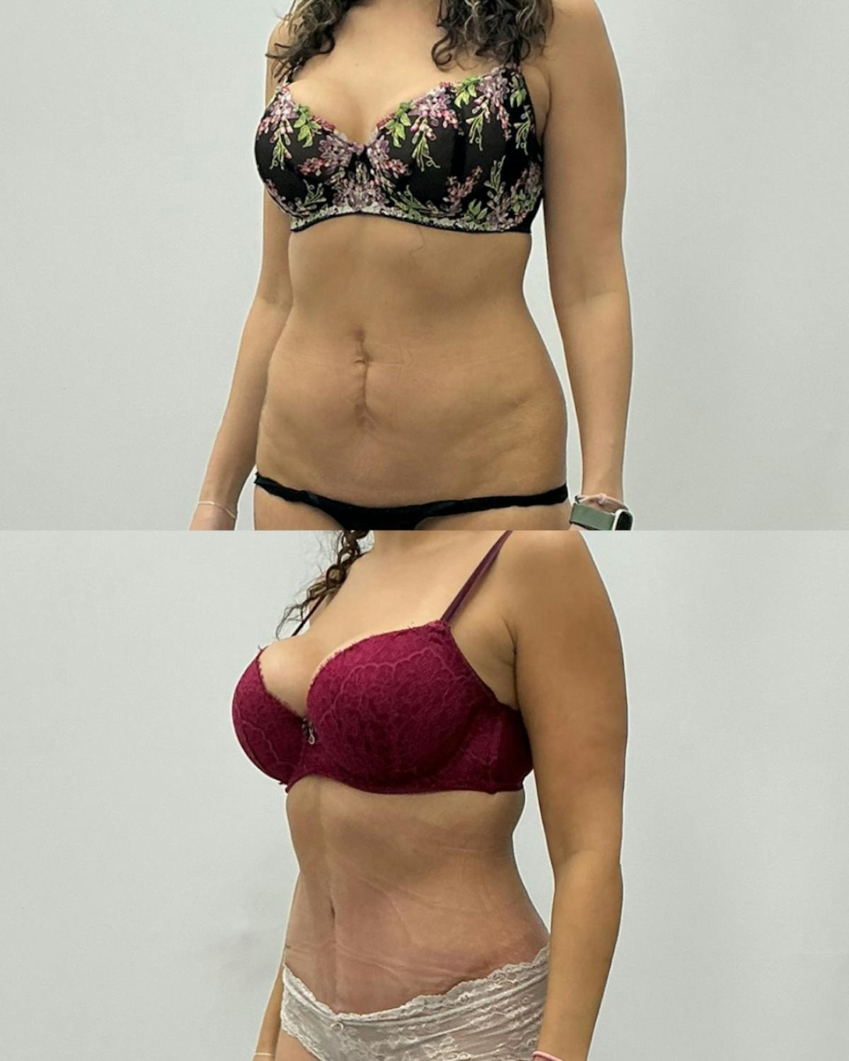 Tummy Tuck Before & After Gallery - Patient 202749 - Image 2