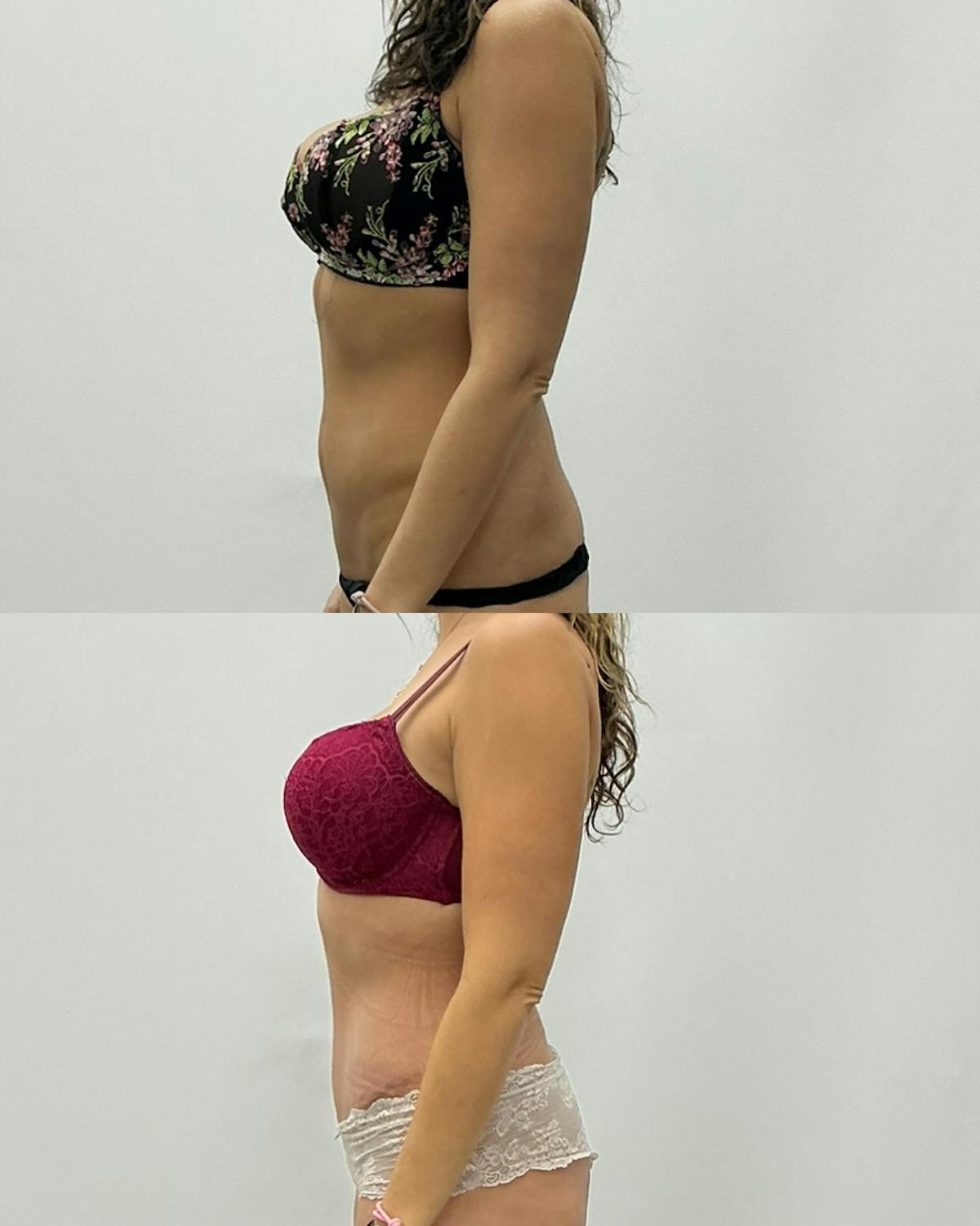 Tummy Tuck Before & After Gallery - Patient 202749 - Image 3