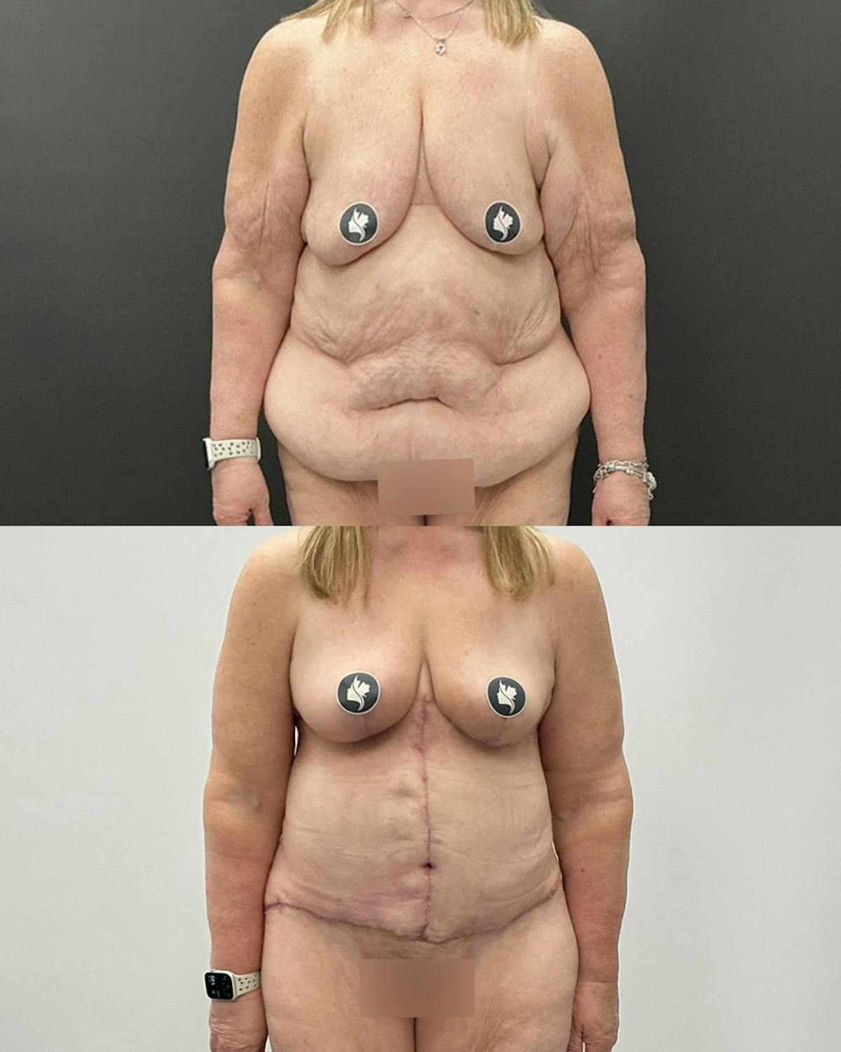 Post-Bariatric Body Contouring Before & After Gallery - Patient 628321 - Image 1