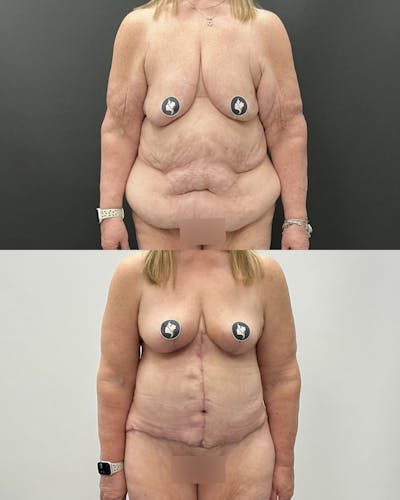 Post-Bariatric Body Contouring Before & After Gallery - Patient 628321 - Image 1