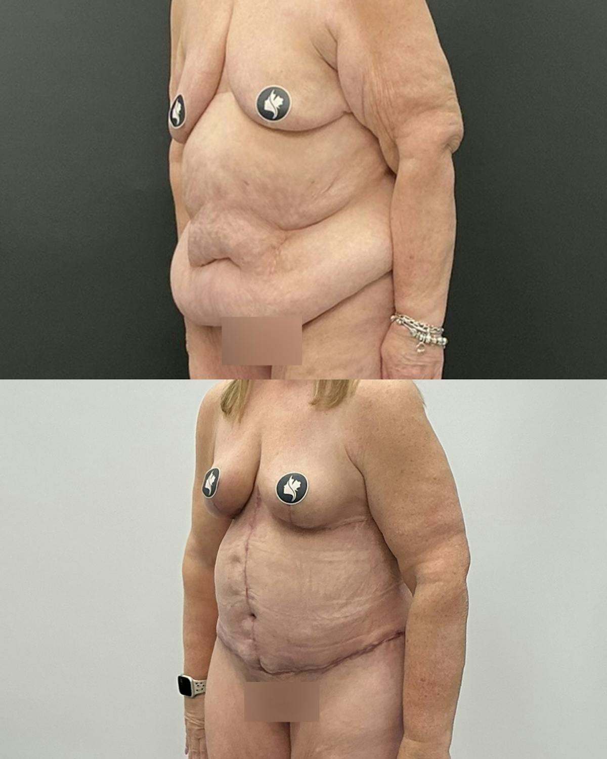 Tummy Tuck Before & After Gallery - Patient 114455 - Image 2