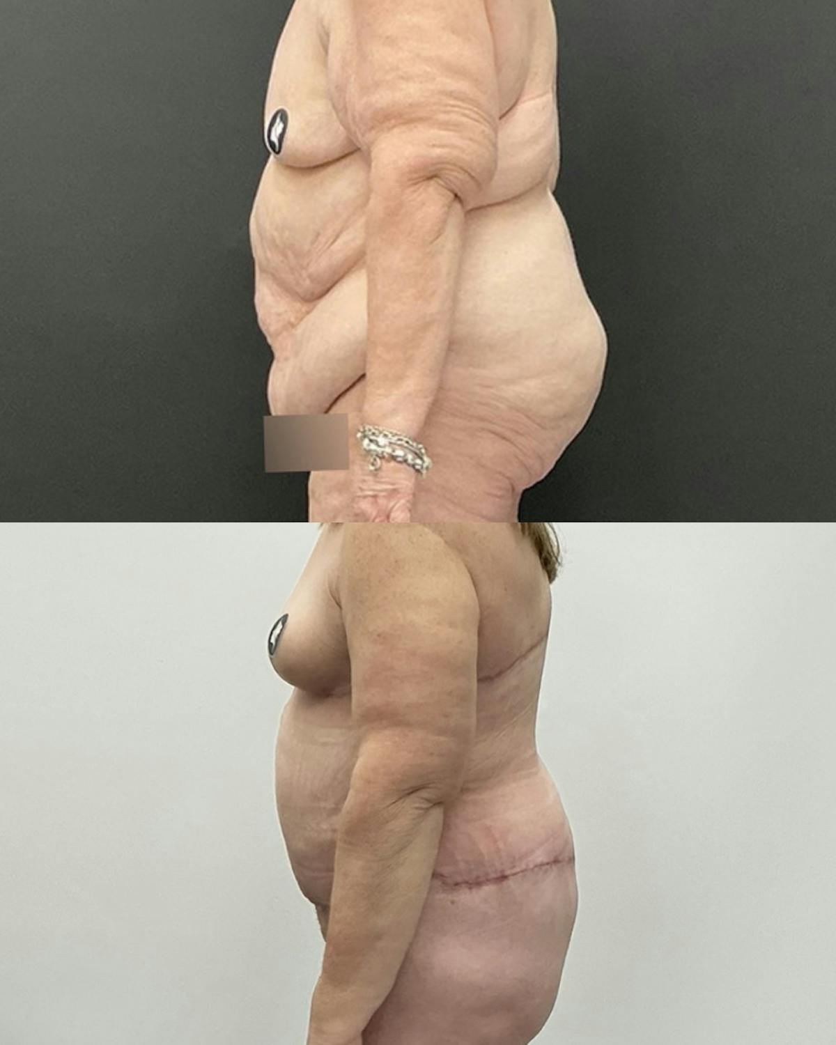 Tummy Tuck Before & After Gallery - Patient 114455 - Image 3