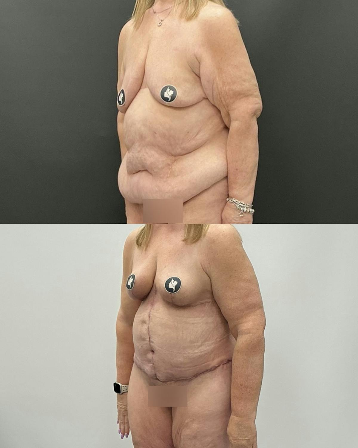 Post-Bariatric Body Contouring Before & After Gallery - Patient 628321 - Image 2