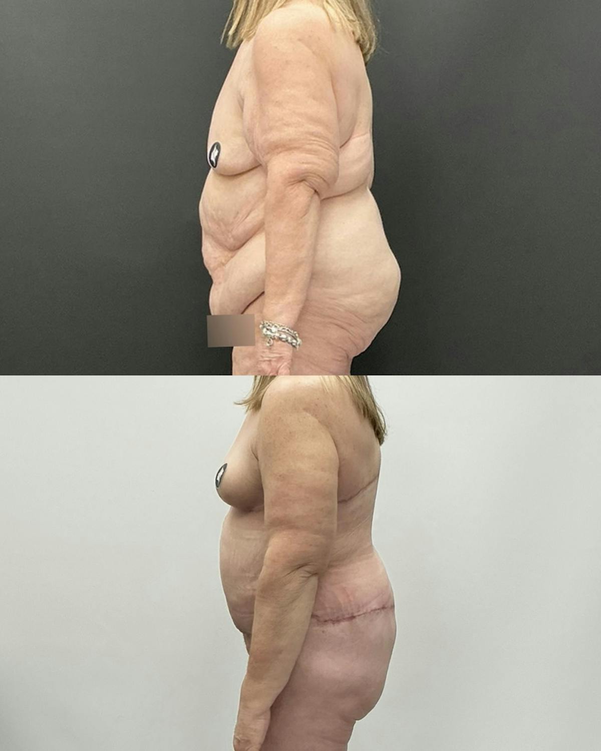 Post-Bariatric Body Contouring Before & After Gallery - Patient 628321 - Image 3