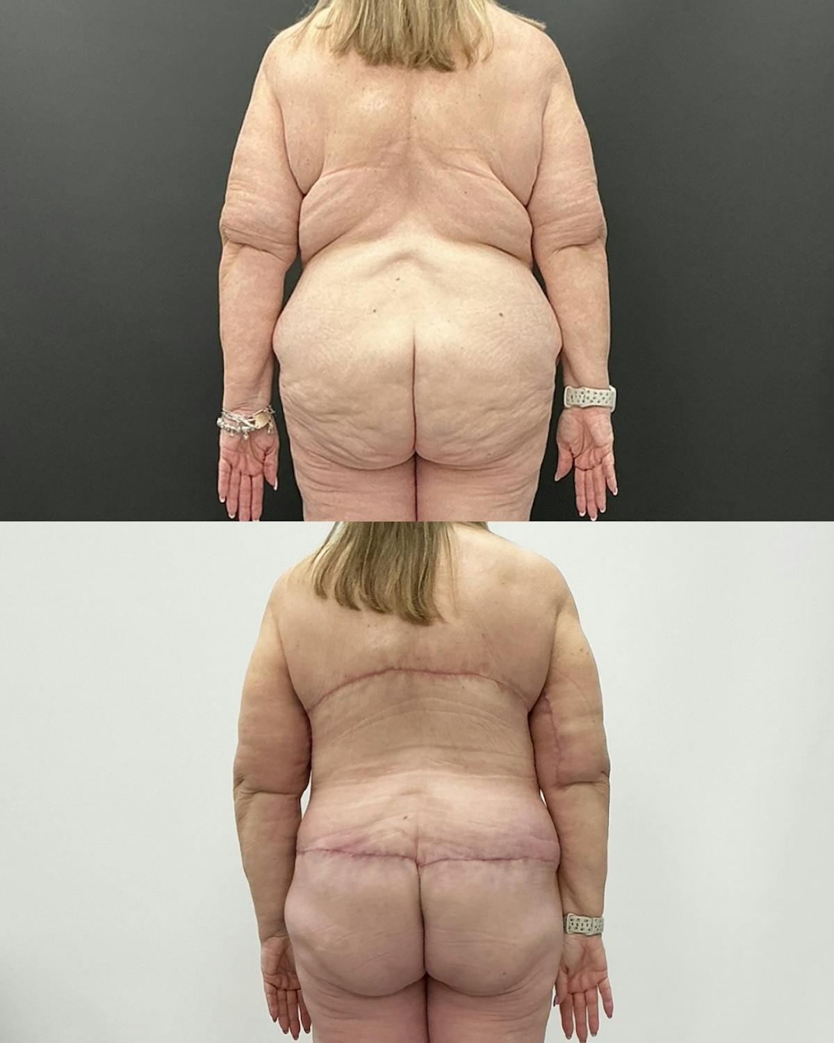 Post-Bariatric Body Contouring Before & After Gallery - Patient 628321 - Image 4