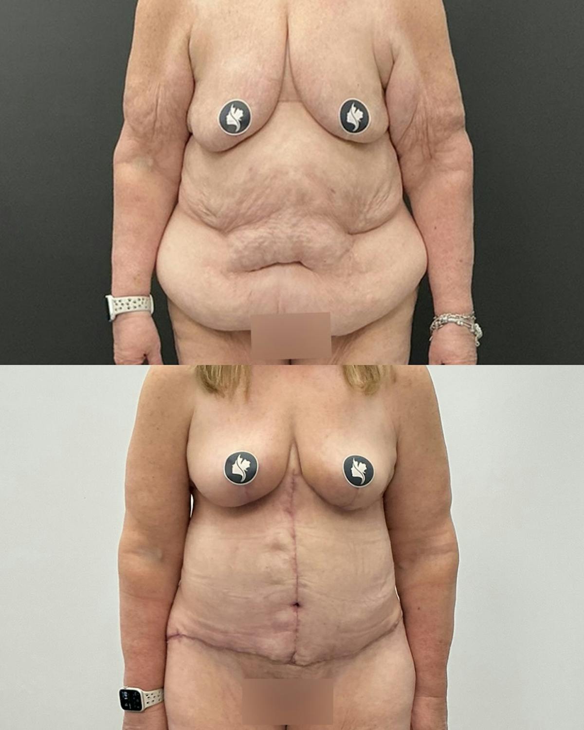 Tummy Tuck Before & After Gallery - Patient 114455 - Image 1