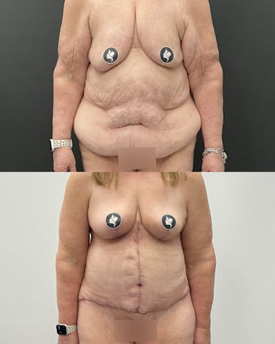 Tummy Tuck Before & After Gallery - Patient 114455 - Image 1