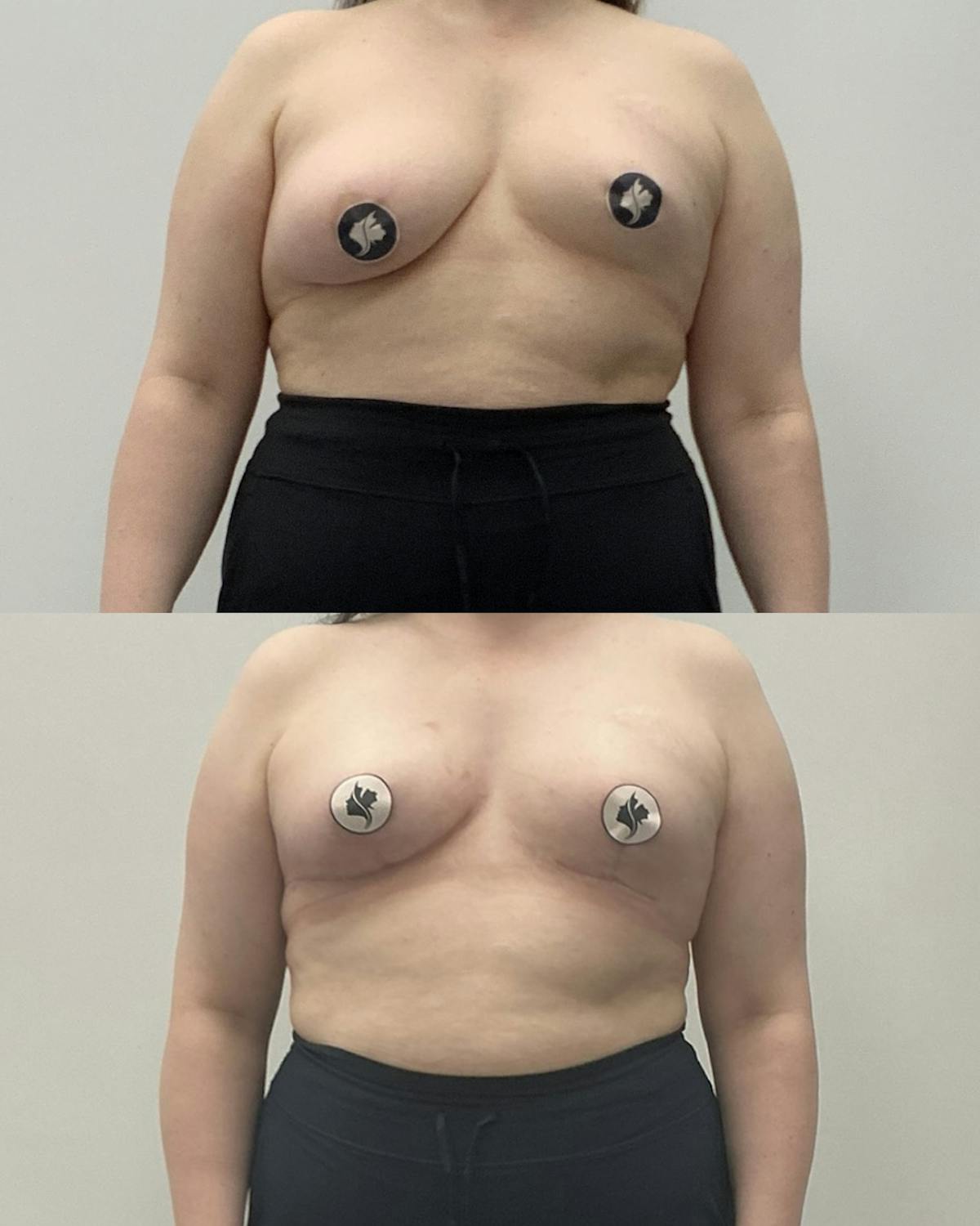Breast Asymmetry Correction Before & After Gallery - Patient 124467 - Image 1
