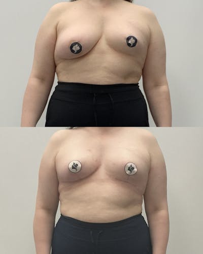 Breast Asymmetry Correction Before & After Gallery - Patient 124467 - Image 1