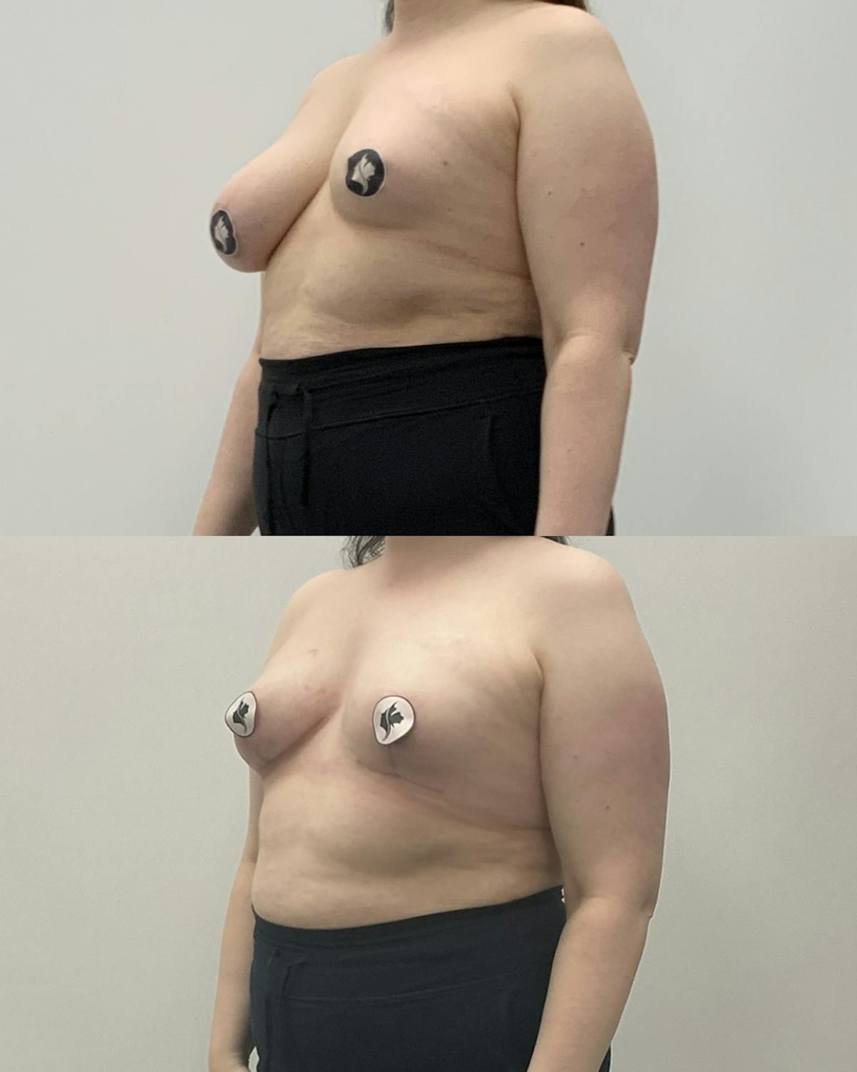 Breast Asymmetry Correction Before & After Gallery - Patient 124467 - Image 2