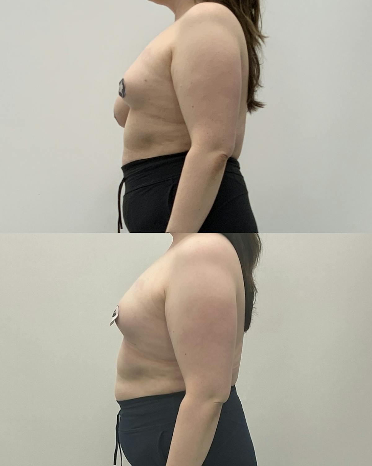 Breast Asymmetry Correction Before & After Gallery - Patient 124467 - Image 3