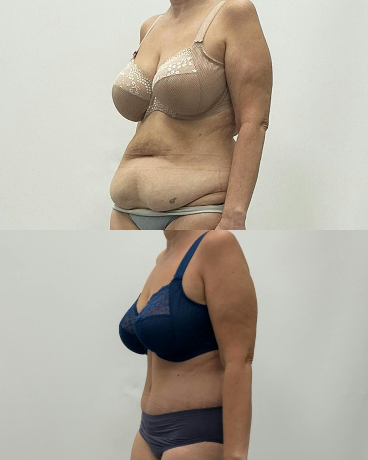 Tummy Tuck Before & After Gallery - Patient 207560 - Image 2