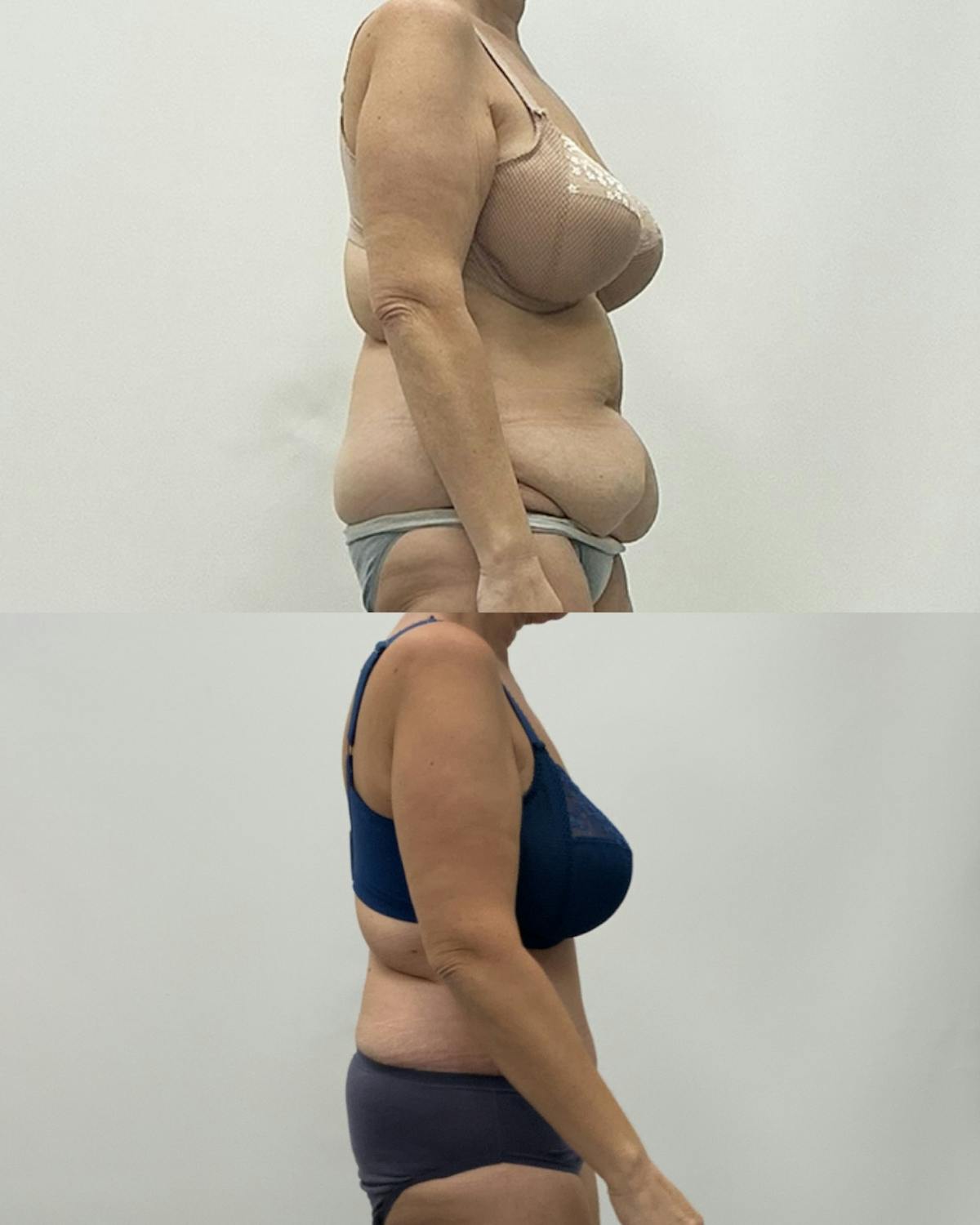 Tummy Tuck Before & After Gallery - Patient 207560 - Image 3
