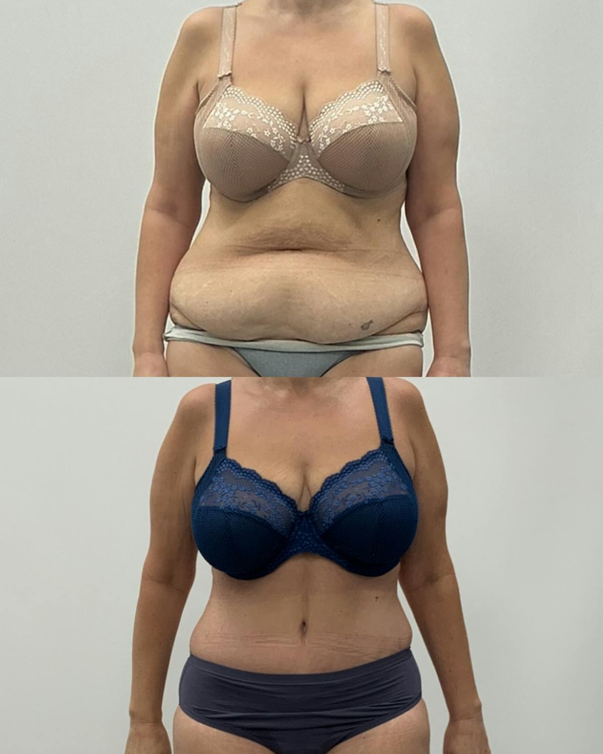 Tummy Tuck Before & After Gallery - Patient 207560 - Image 1